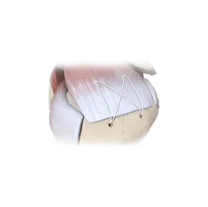 Sports medicine - suture anchors and interface screws